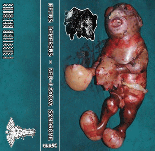 Fetus Demersus : Neu-Laxova Syndrome